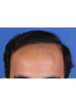 After Hair Transplant&nbsp;Front